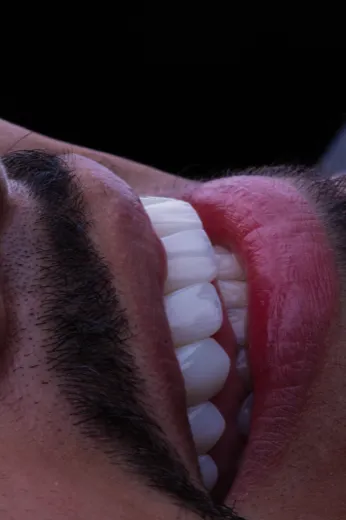Implantes dentários